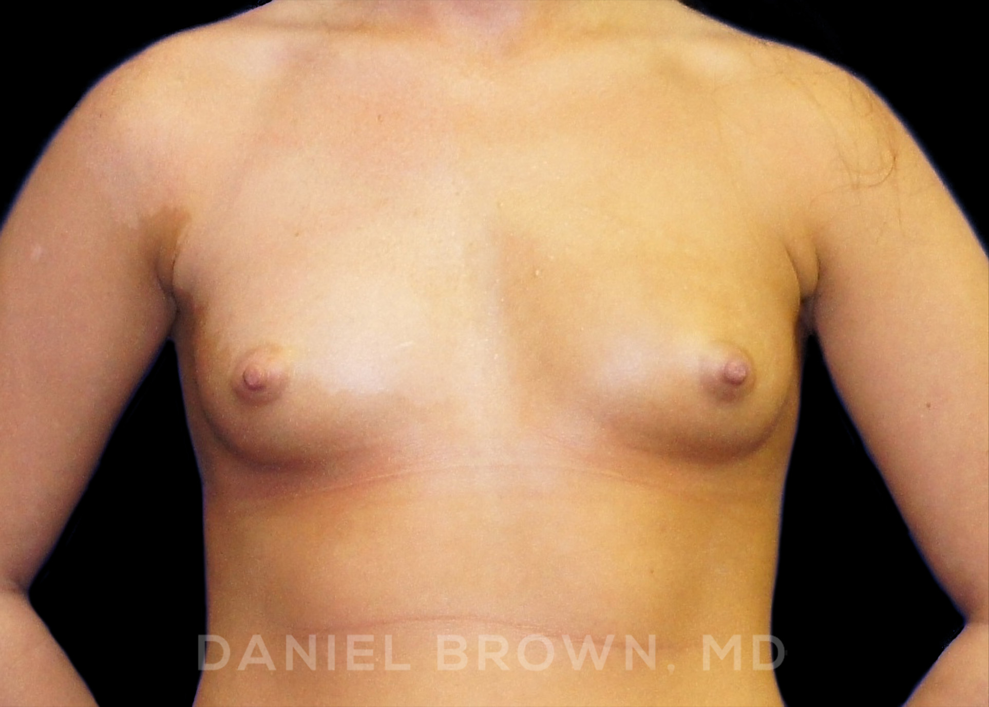 Breast Augmentation Patient Photo - Case 2126 - before view-