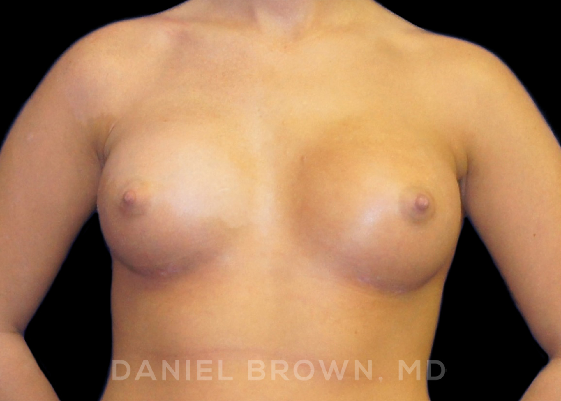 Breast Augmentation Patient Photo - Case 2126 - after view