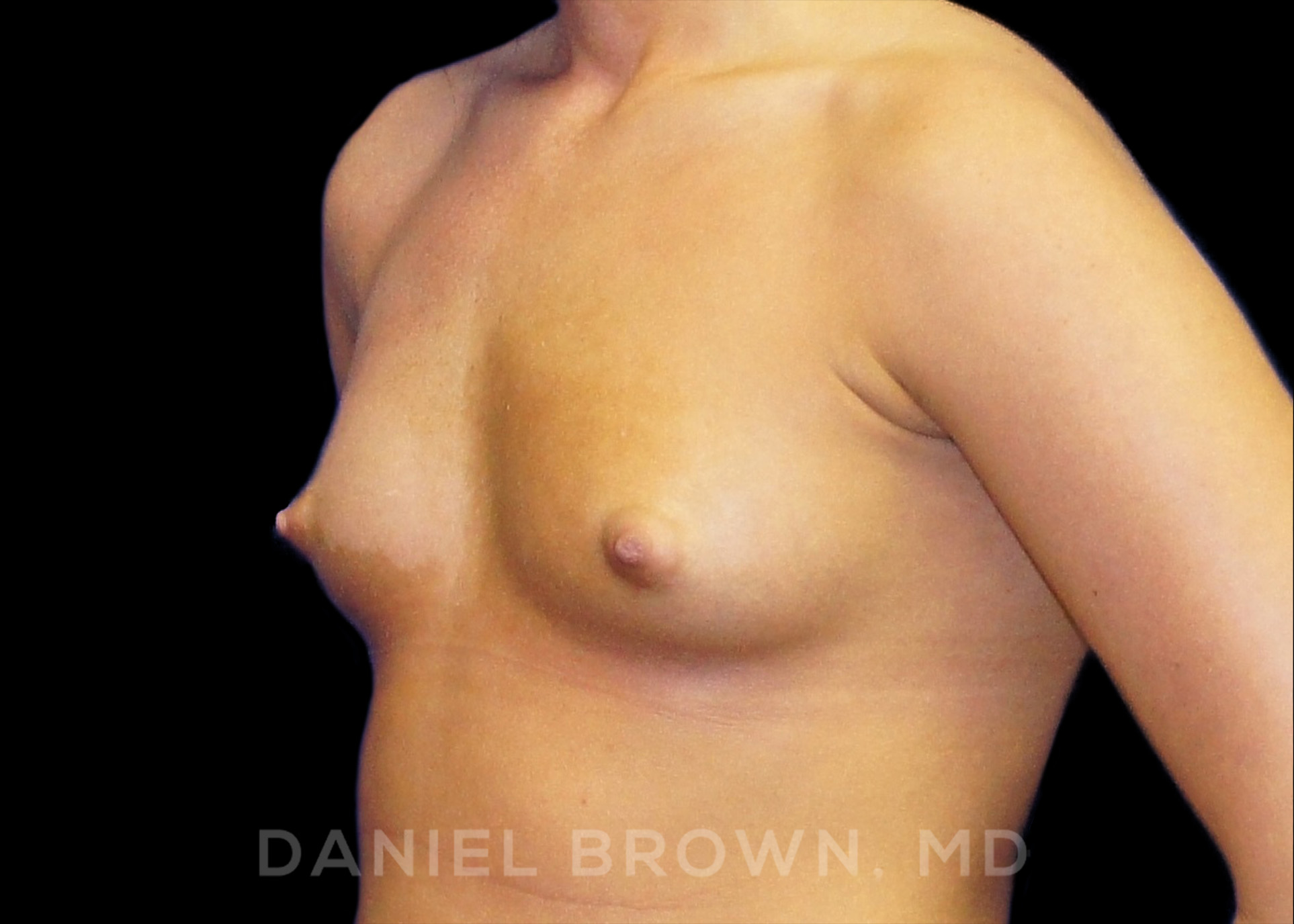 Breast Augmentation Patient Photo - Case 2126 - before view-