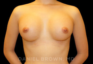 Breast Augmentation - Case 2137 - After
