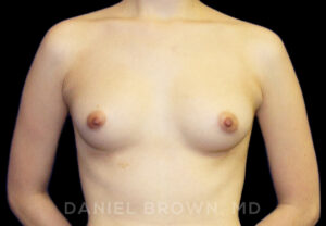 Breast Augmentation - Case 2137 - Before
