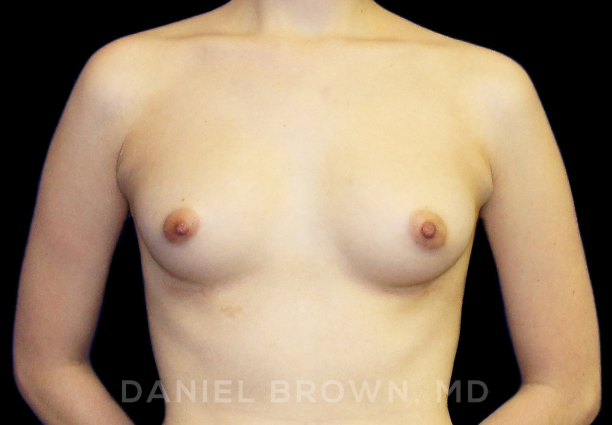 Breast Augmentation Patient Photo - Case 2137 - before view-0