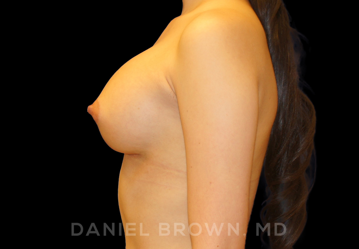 Breast Augmentation Patient Photo - Case 2137 - after view-3