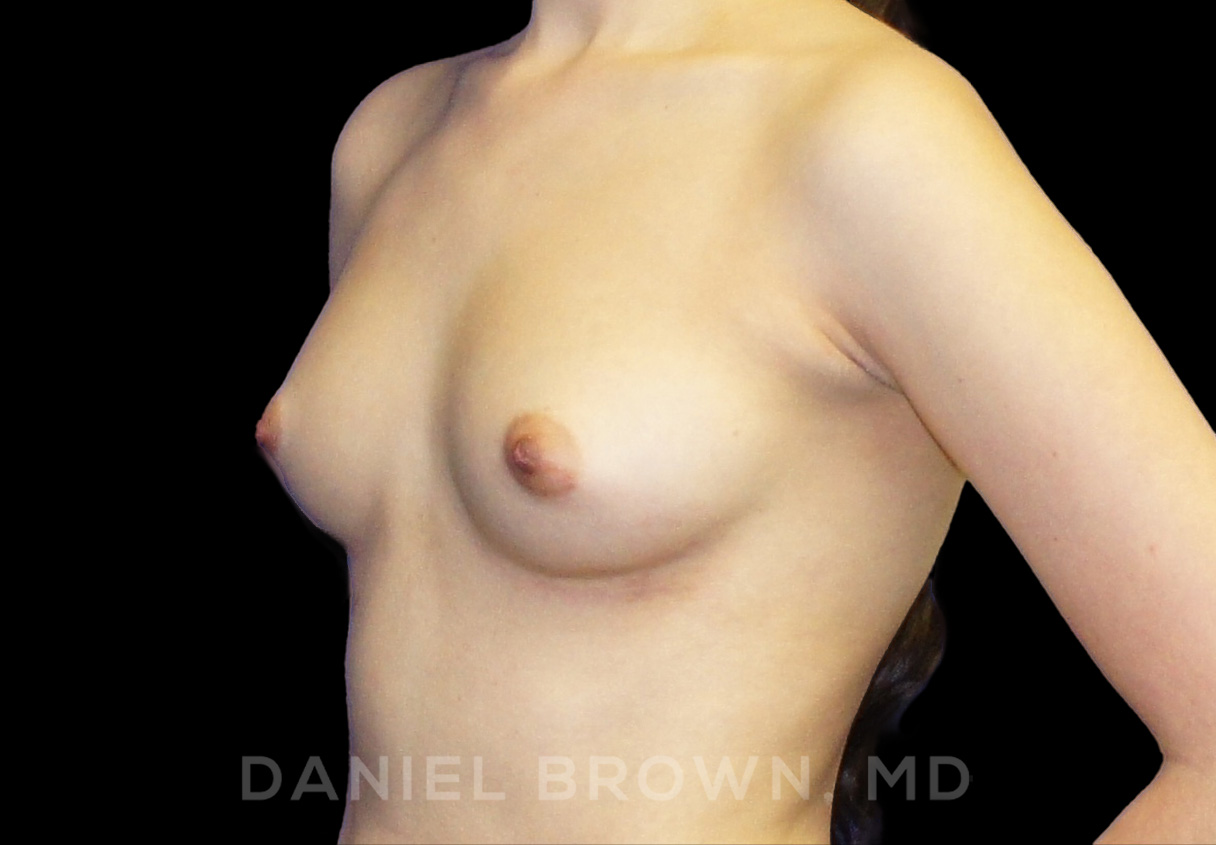 Breast Augmentation Patient Photo - Case 2137 - before view-1