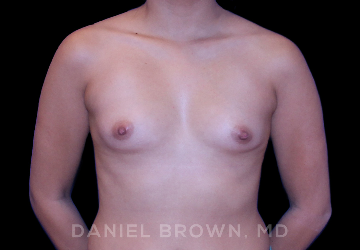 Breast Augmentation Patient Photo - Case 2148 - before view-0