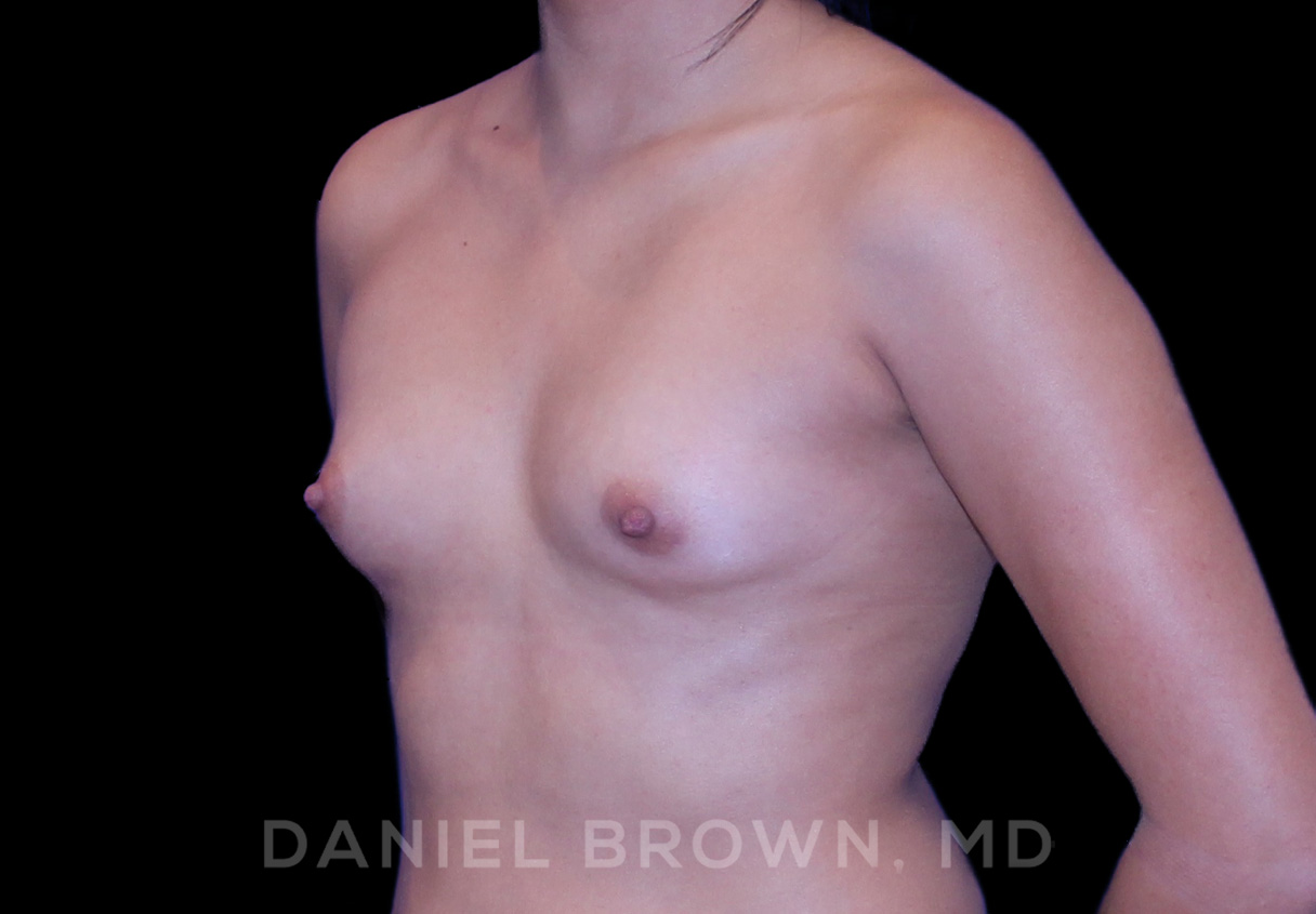 Breast Augmentation Patient Photo - Case 2148 - before view-1