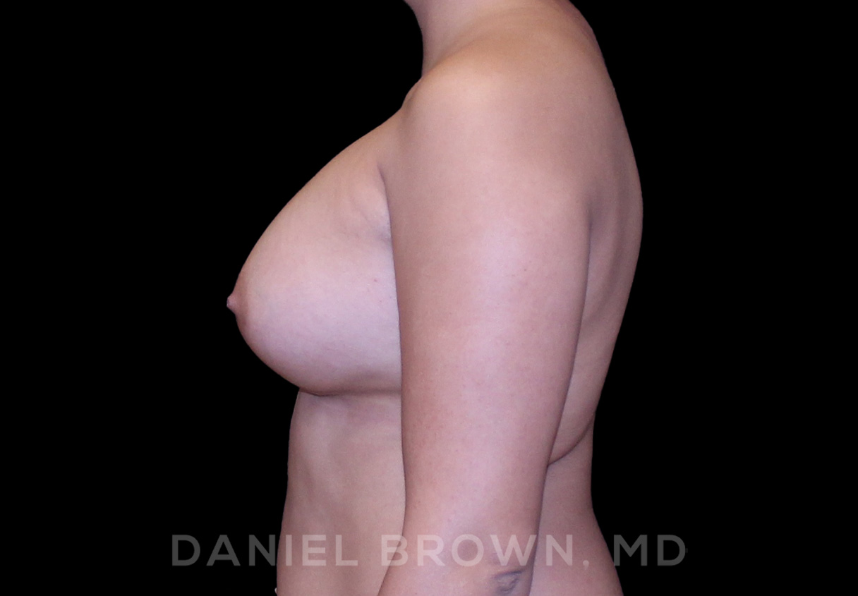 Breast Augmentation Patient Photo - Case 2148 - after view-3