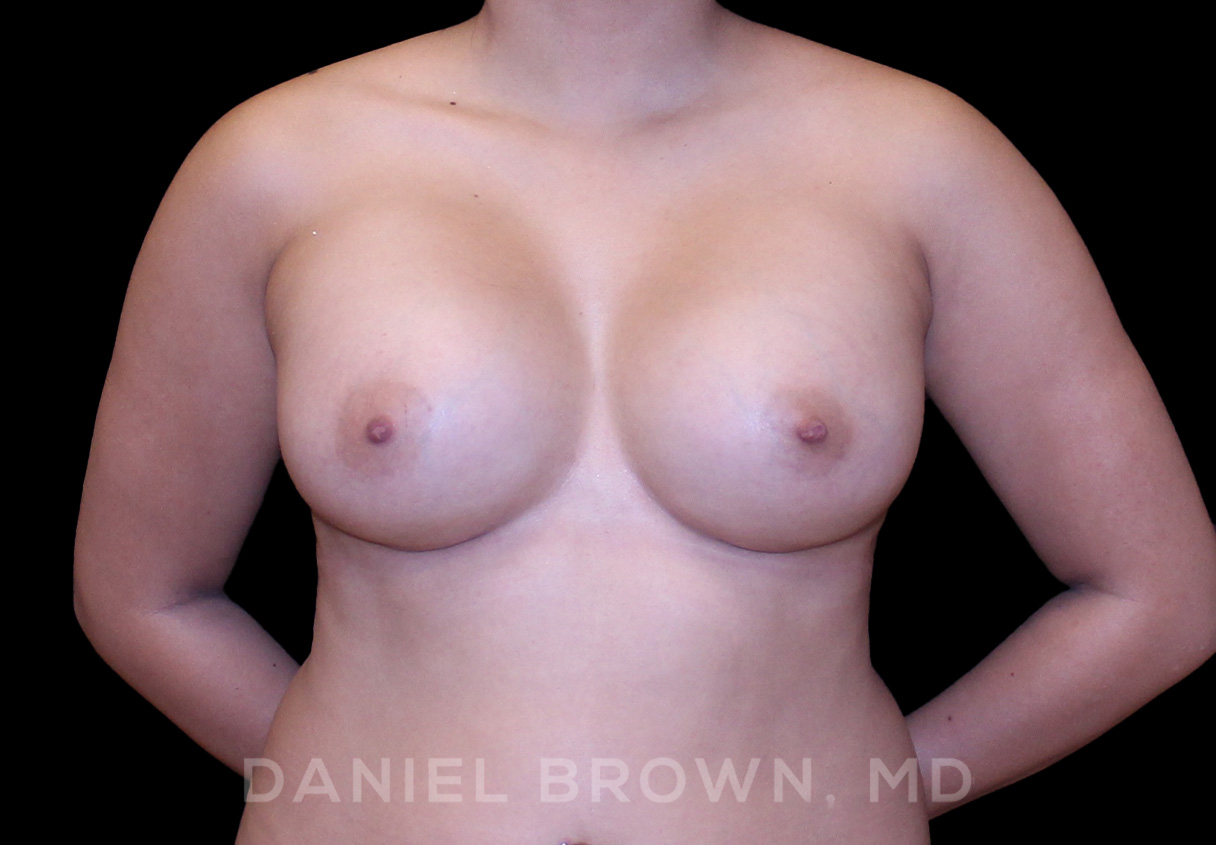 Breast Augmentation Patient Photo - Case 2148 - after view-0