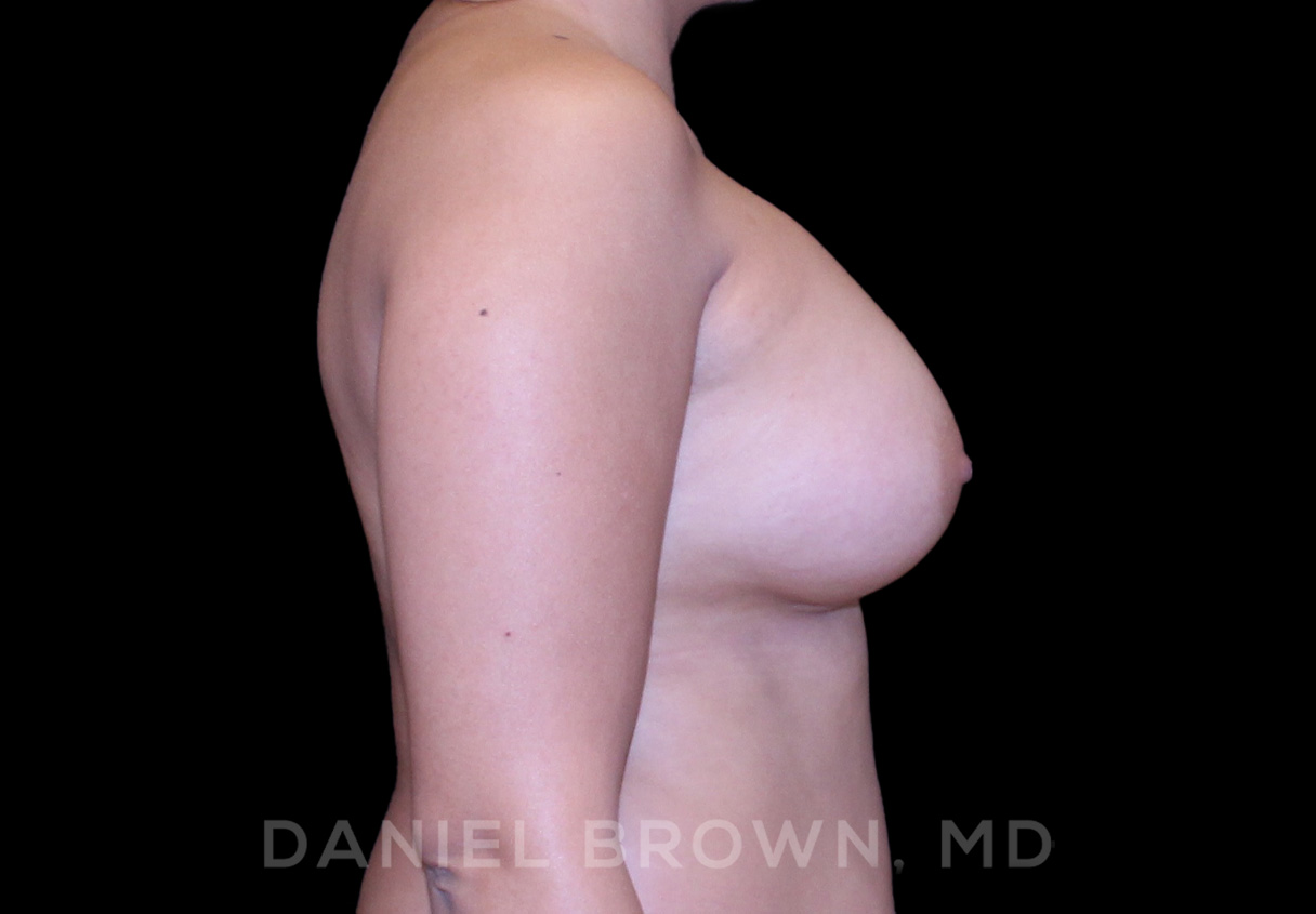 Breast Augmentation Patient Photo - Case 2148 - after view-4