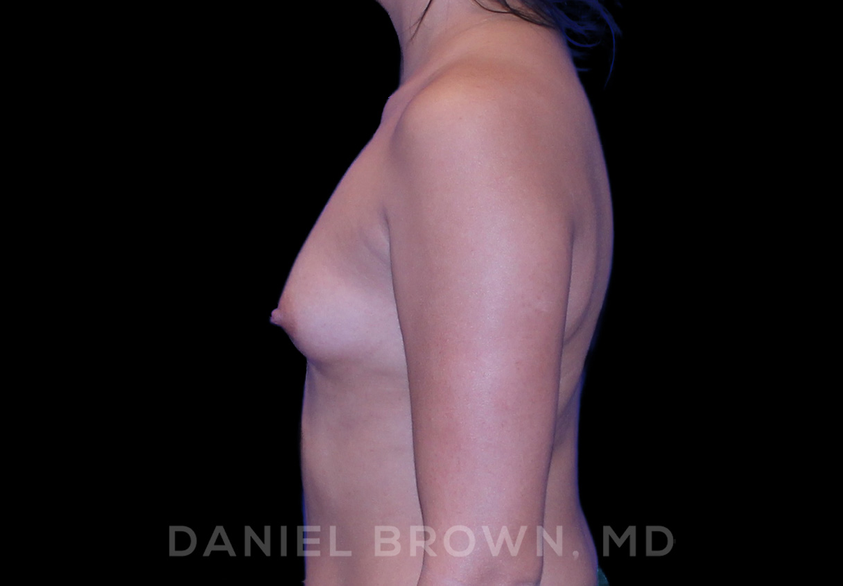Breast Augmentation Patient Photo - Case 2148 - before view-3