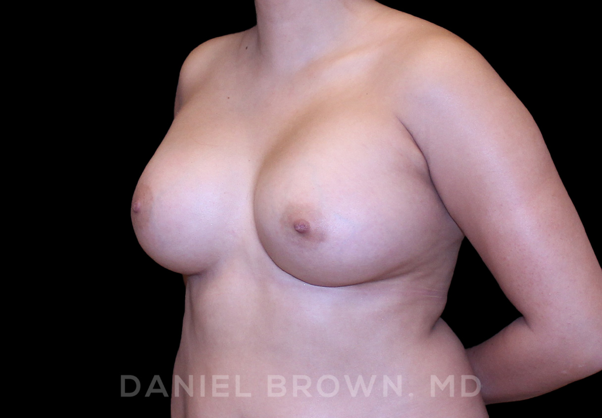 Breast Augmentation Patient Photo - Case 2148 - after view-1