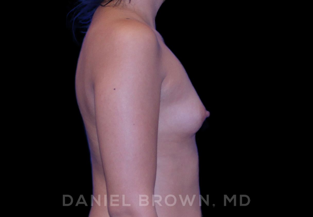 Breast Augmentation Patient Photo - Case 2148 - before view-4