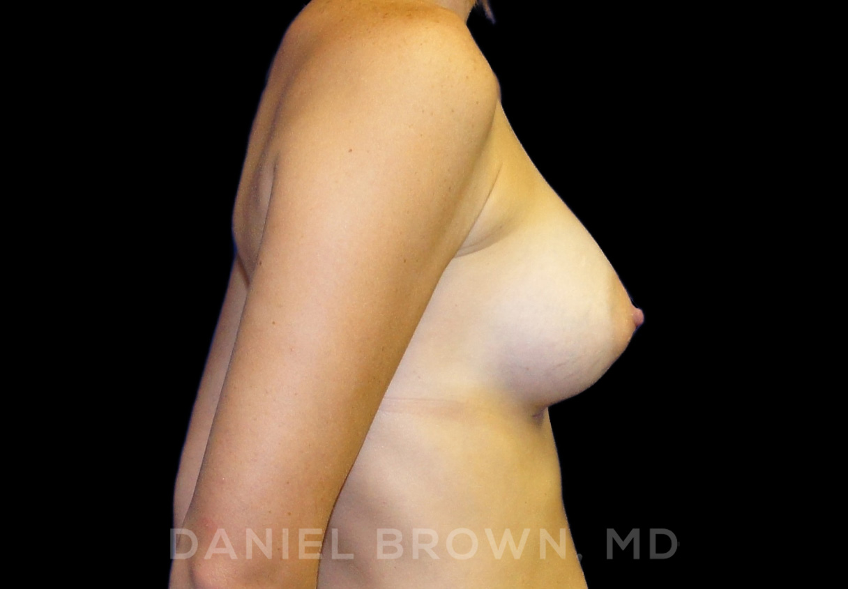 Breast Augmentation Patient Photo - Case 2159 - after view