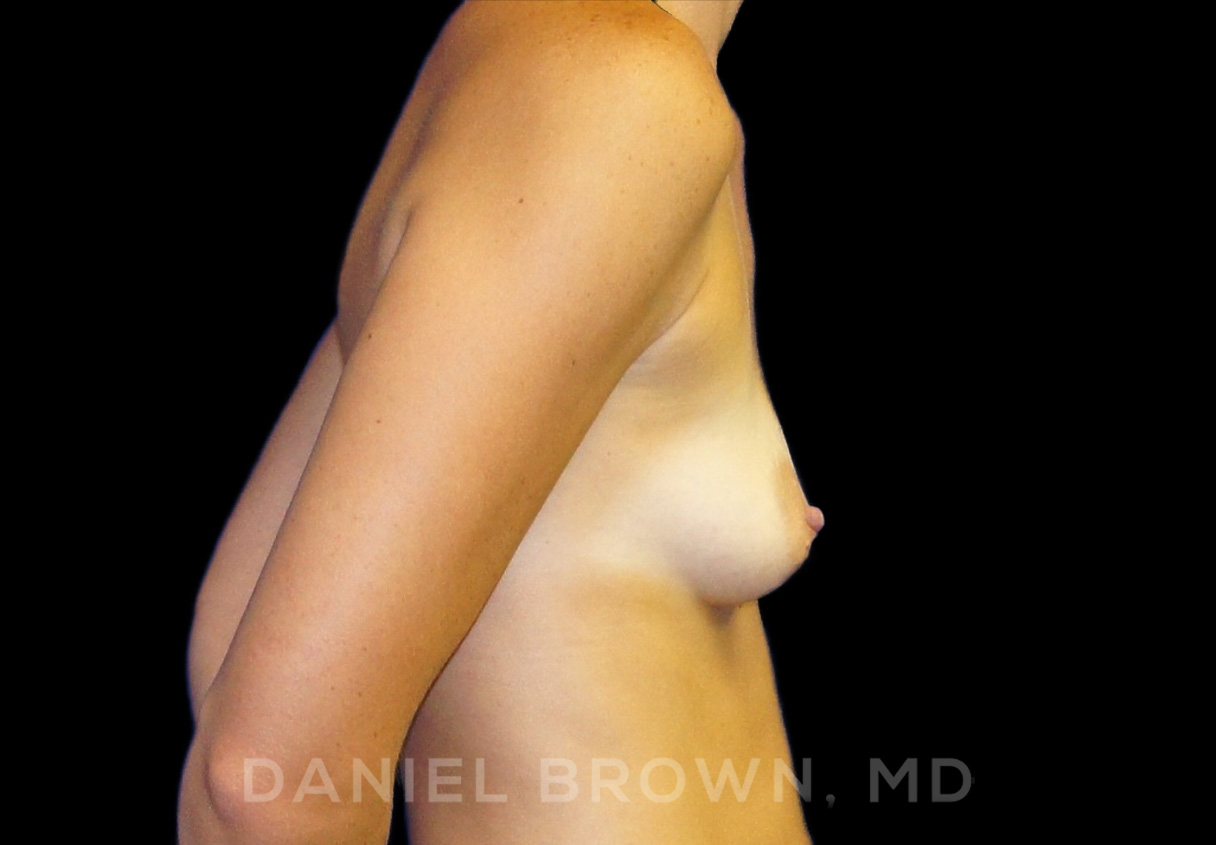 Breast Augmentation Patient Photo - Case 2159 - before view-