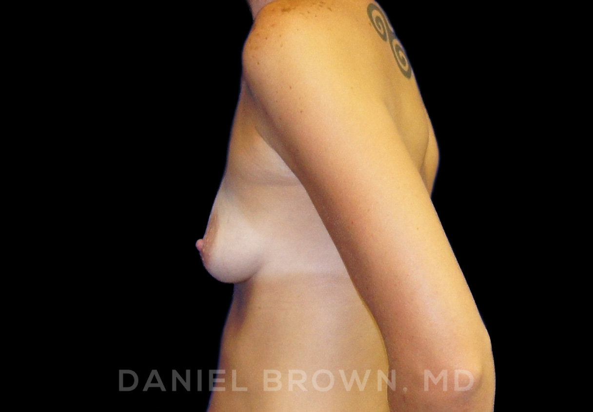 Breast Augmentation Patient Photo - Case 2159 - before view-
