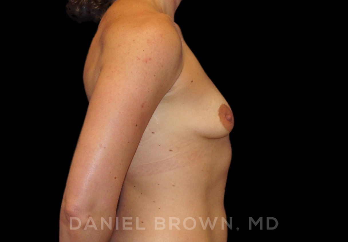 Breast Augmentation Patient Photo - Case 2170 - before view-
