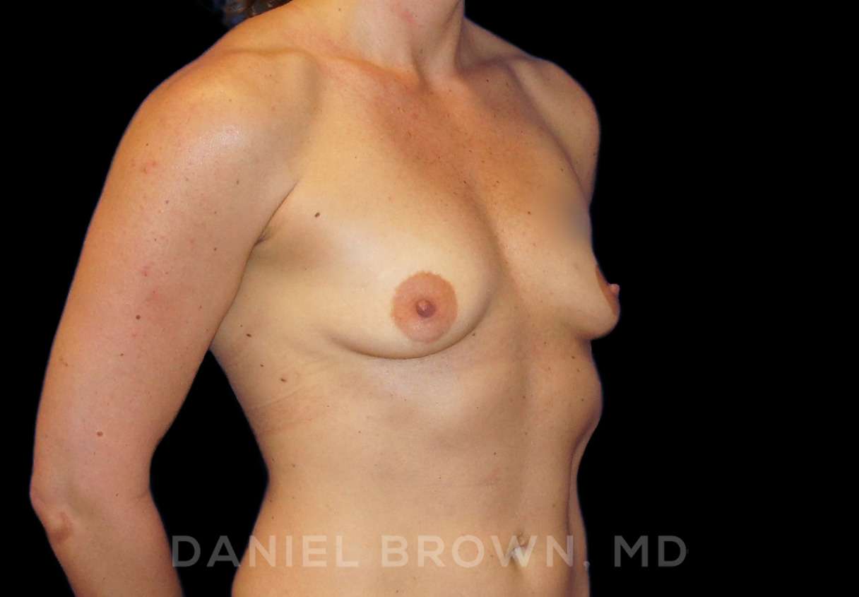 Breast Augmentation Patient Photo - Case 2170 - before view-2