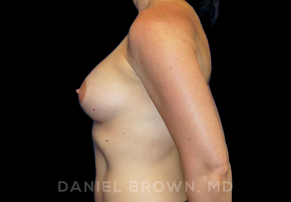 Breast Augmentation Patient Photo - Case 2170 - after view