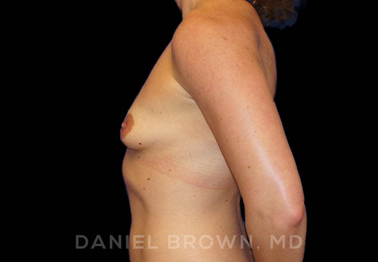 Breast Augmentation Patient Photo - Case 2170 - before view-