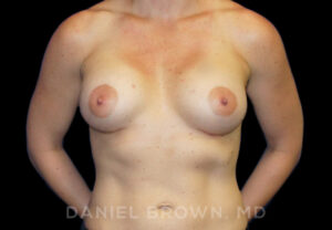 Breast Augmentation - Case 2170 - After