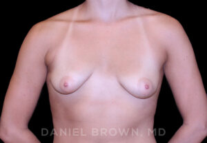 Breast Augmentation - Case 2181 - Before