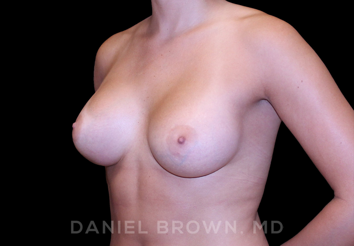 Breast Augmentation Patient Photo - Case 2181 - after view