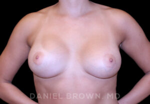 Breast Augmentation - Case 2181 - After