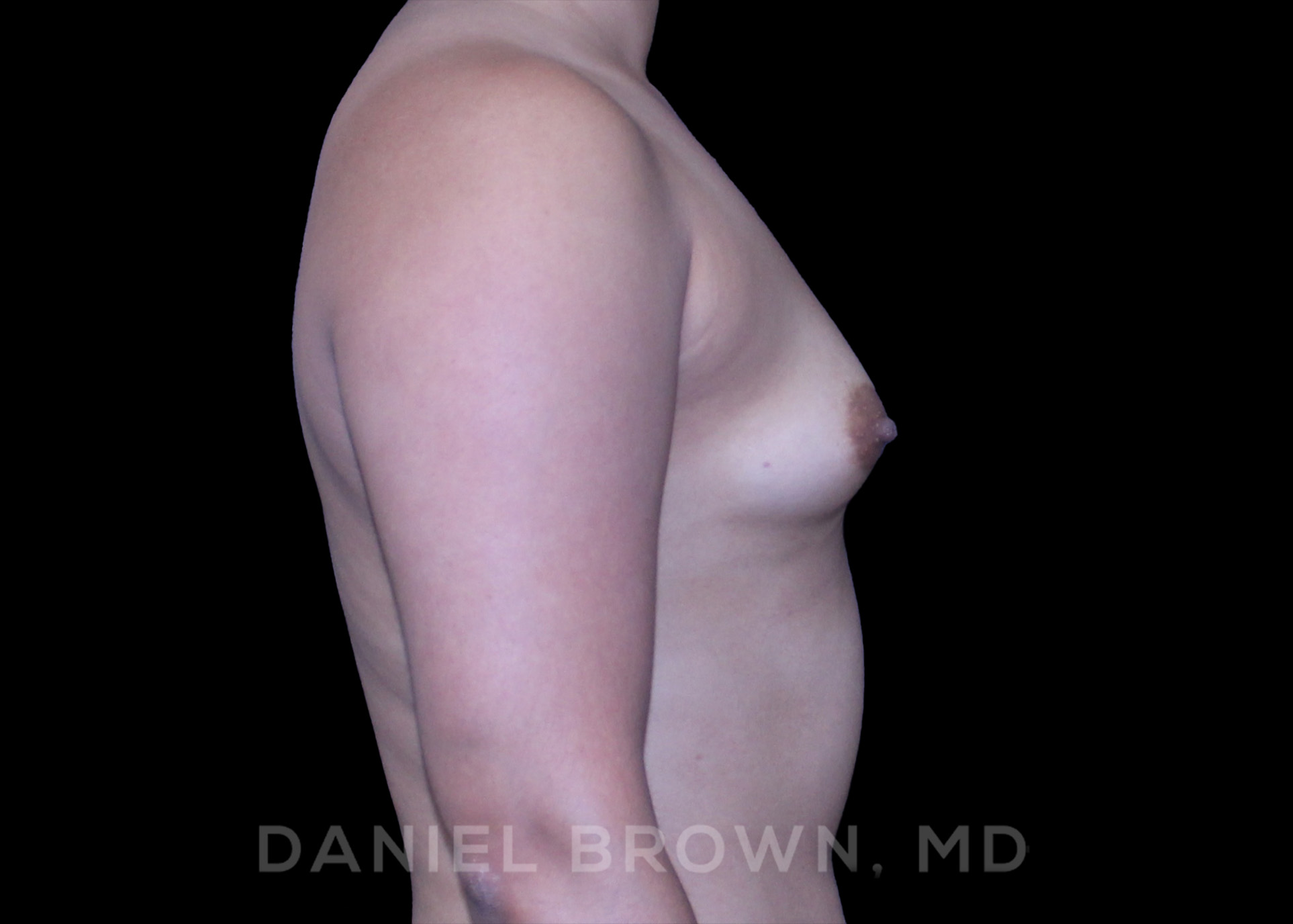 Breast Augmentation Patient Photo - Case 2192 - before view-4