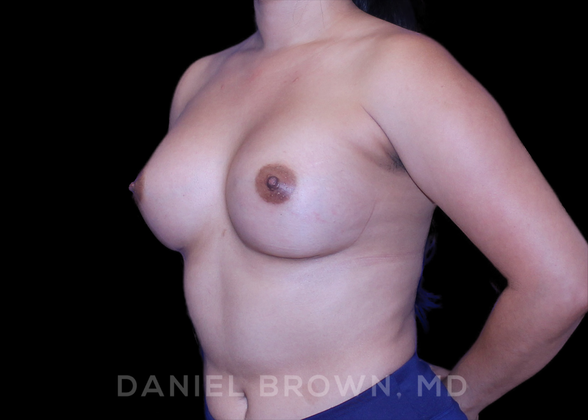 Breast Augmentation Patient Photo - Case 2192 - after view