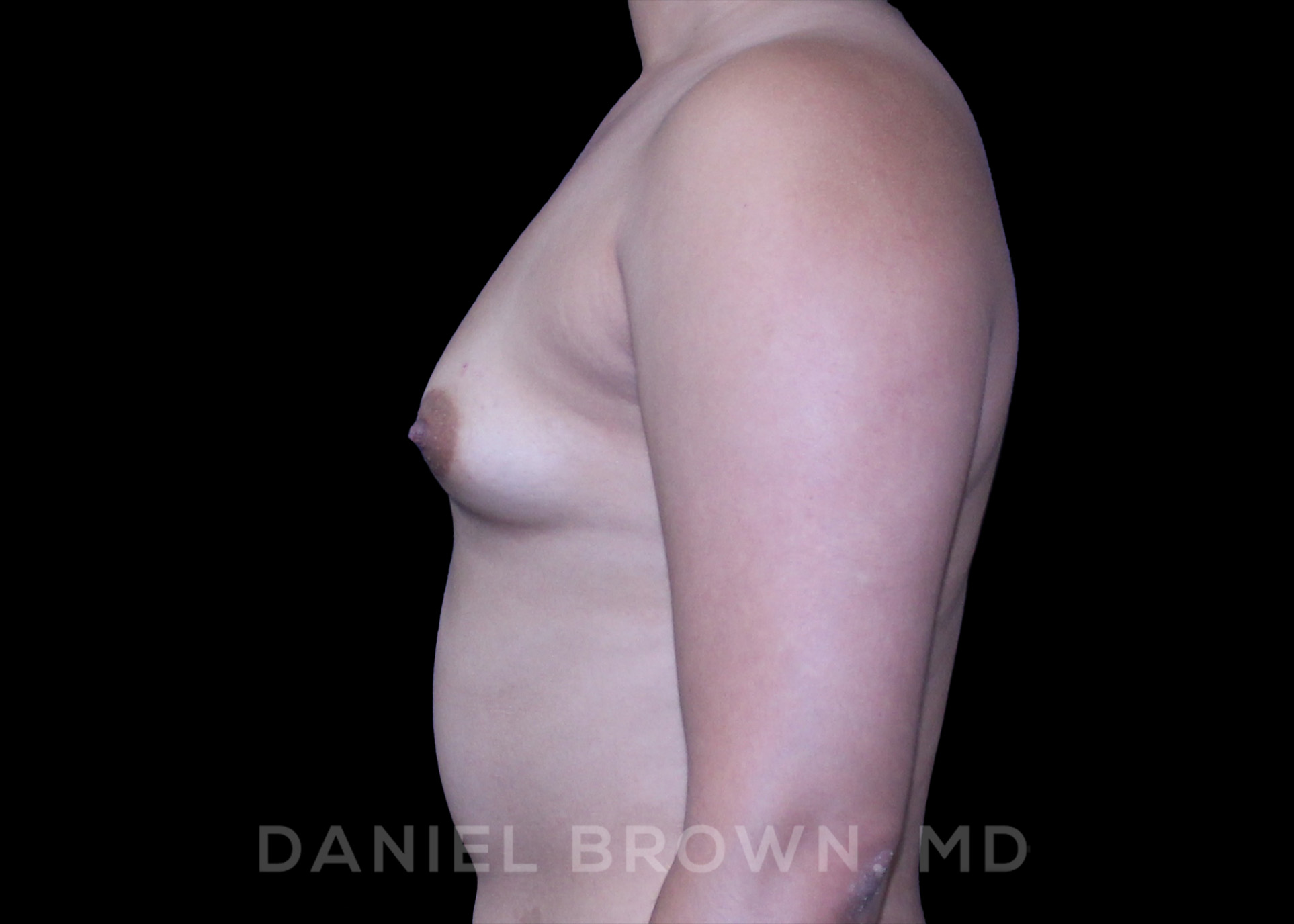 Breast Augmentation Patient Photo - Case 2192 - before view-3