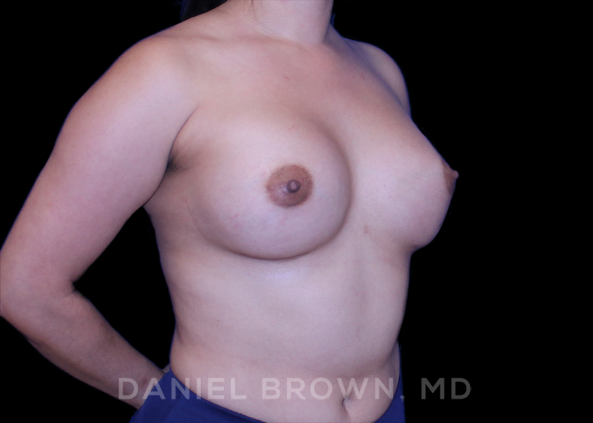 Breast Augmentation Patient Photo - Case 2192 - after view-2
