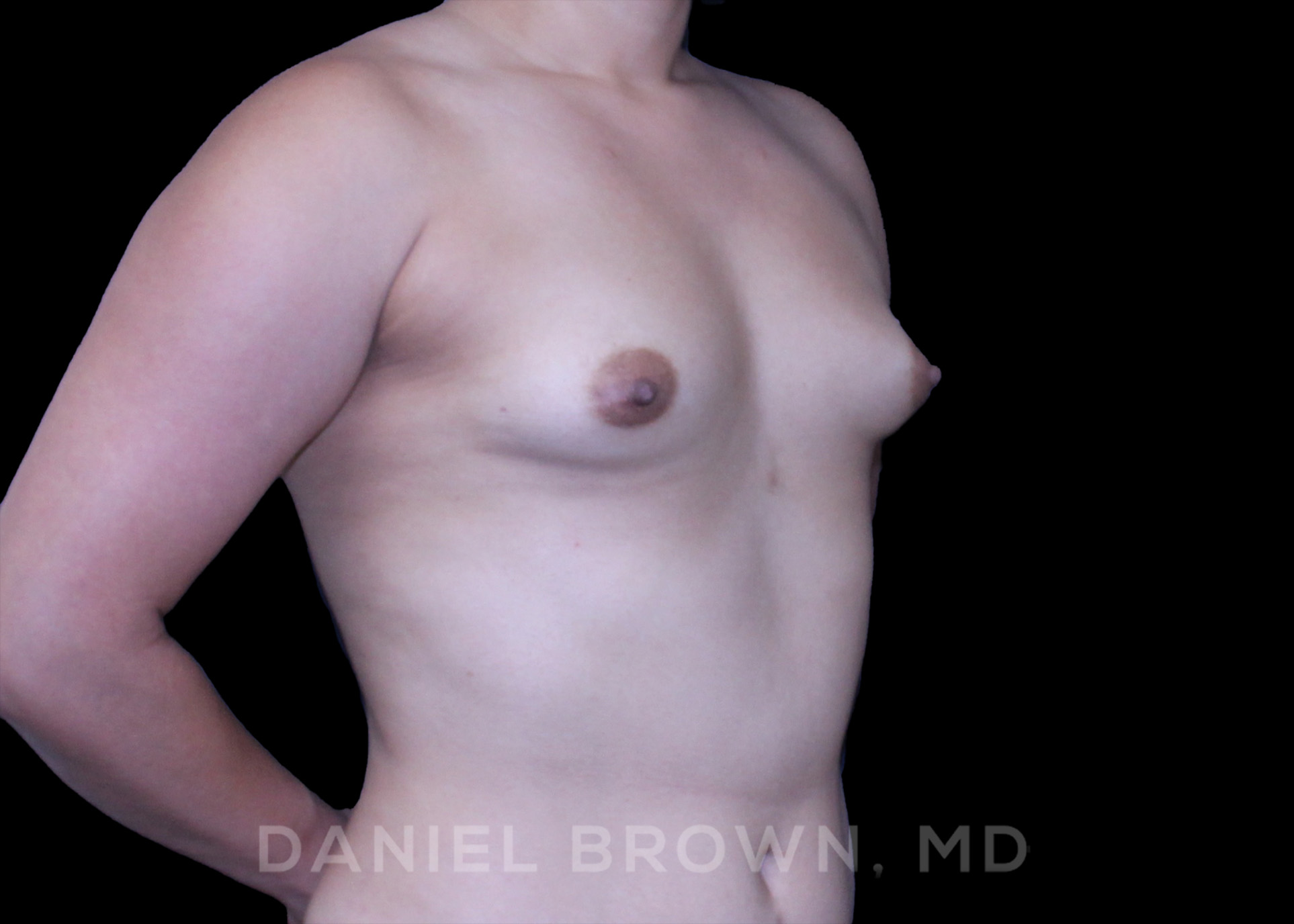 Breast Augmentation Patient Photo - Case 2192 - before view-2