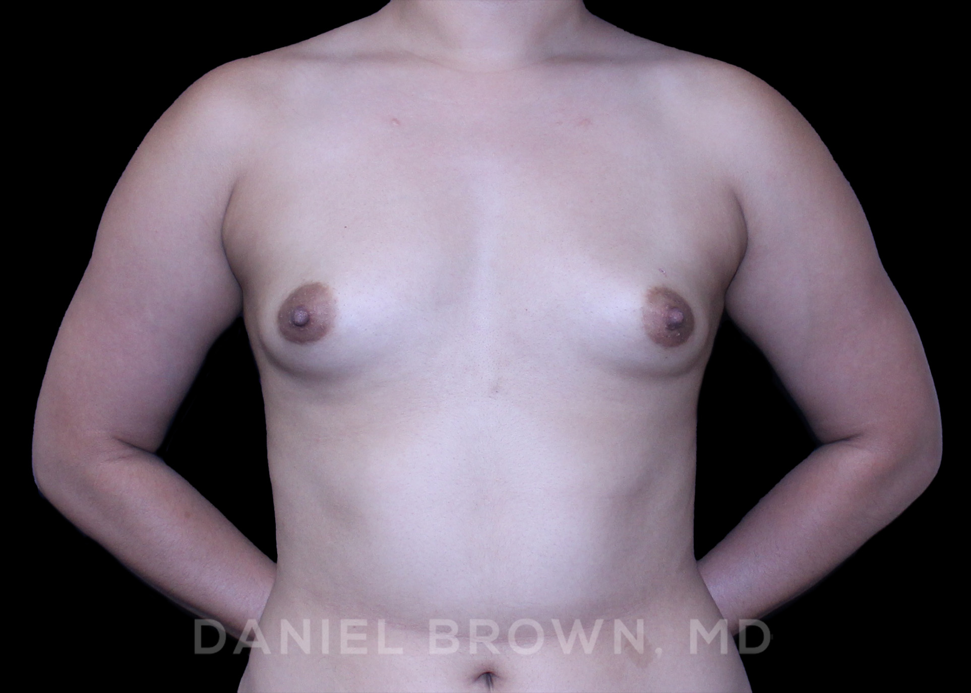 Breast Augmentation Patient Photo - Case 2192 - before view-0