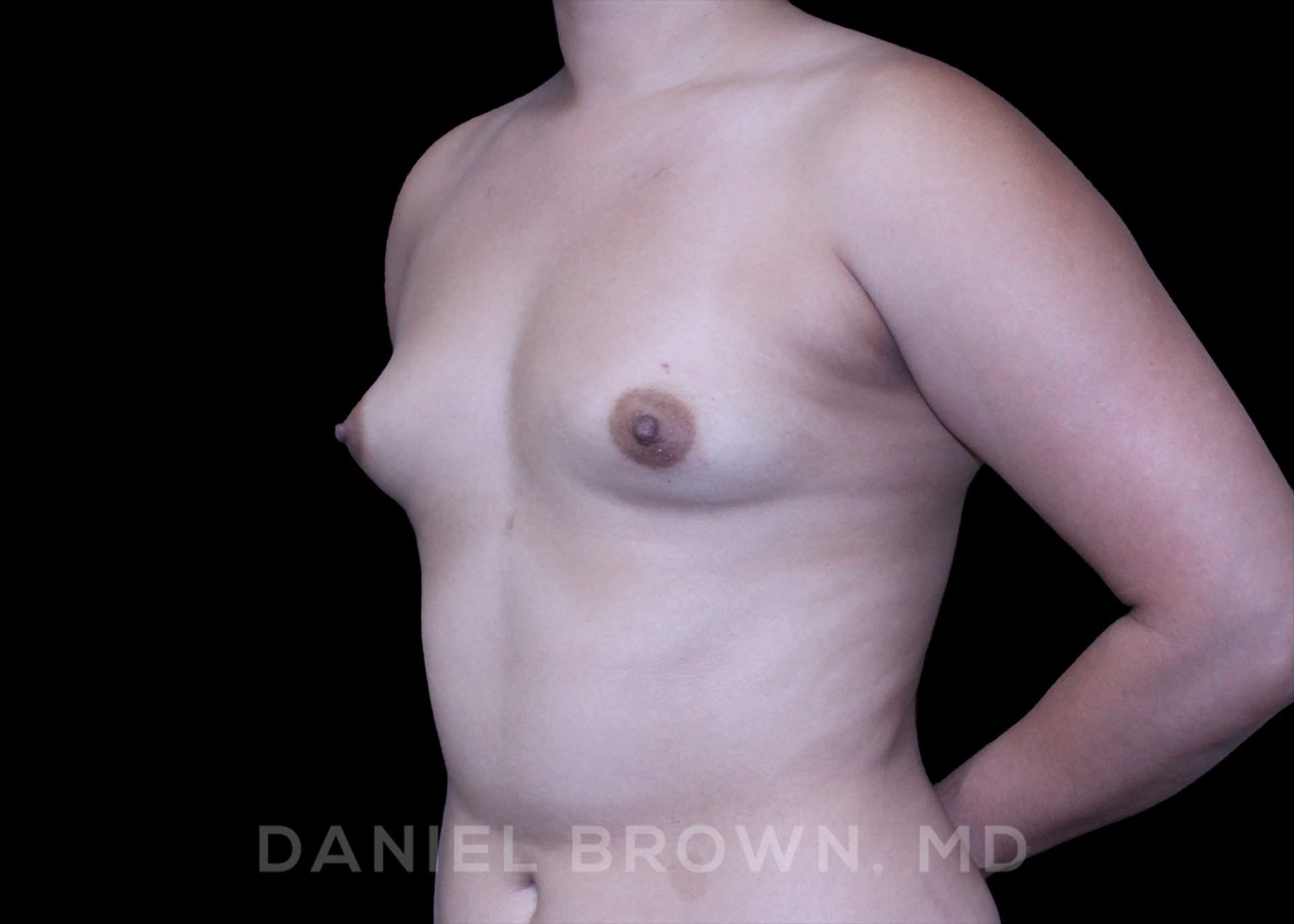 Breast Augmentation Patient Photo - Case 2192 - before view-1