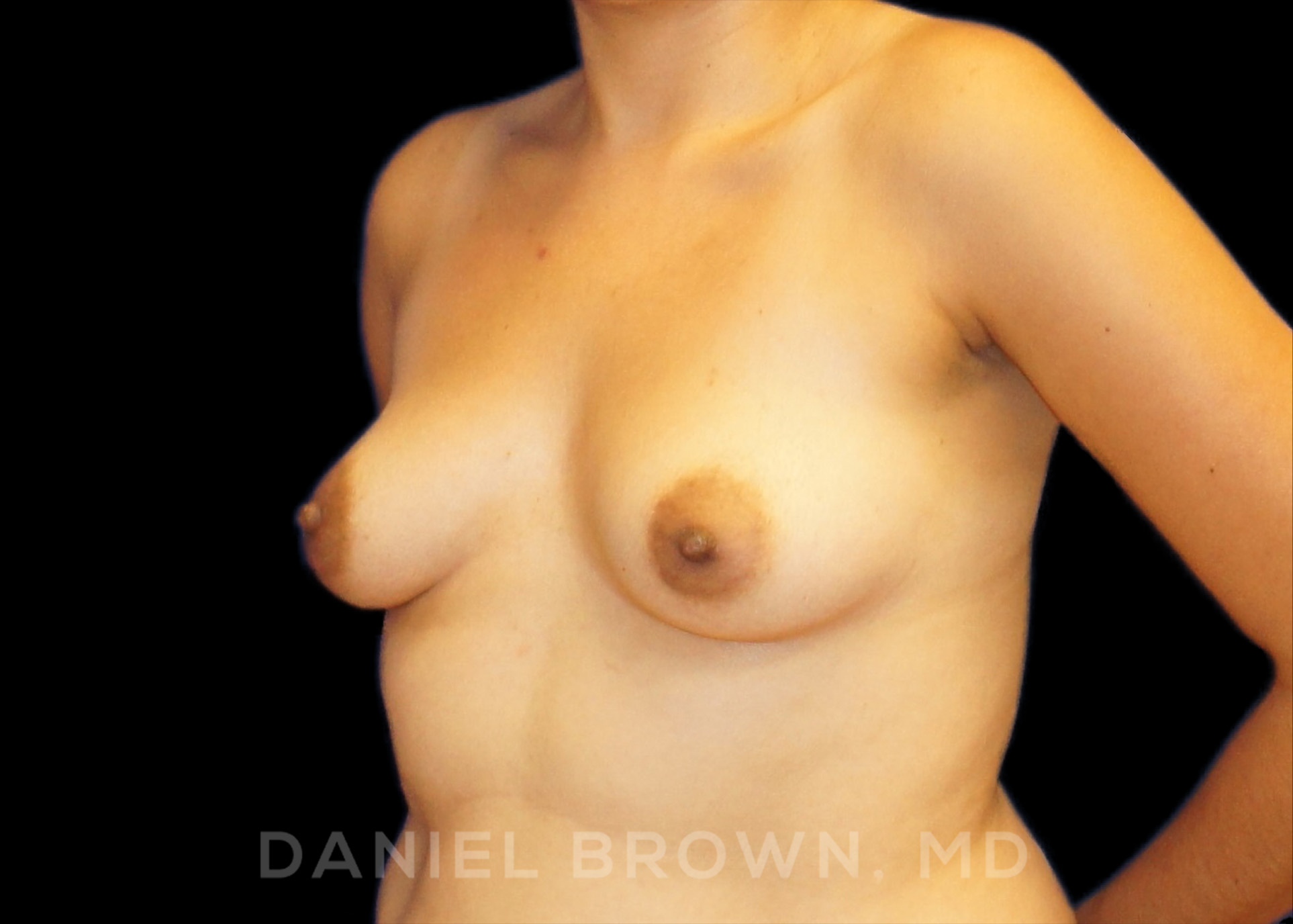 Breast Augmentation Patient Photo - Case 2203 - before view-1
