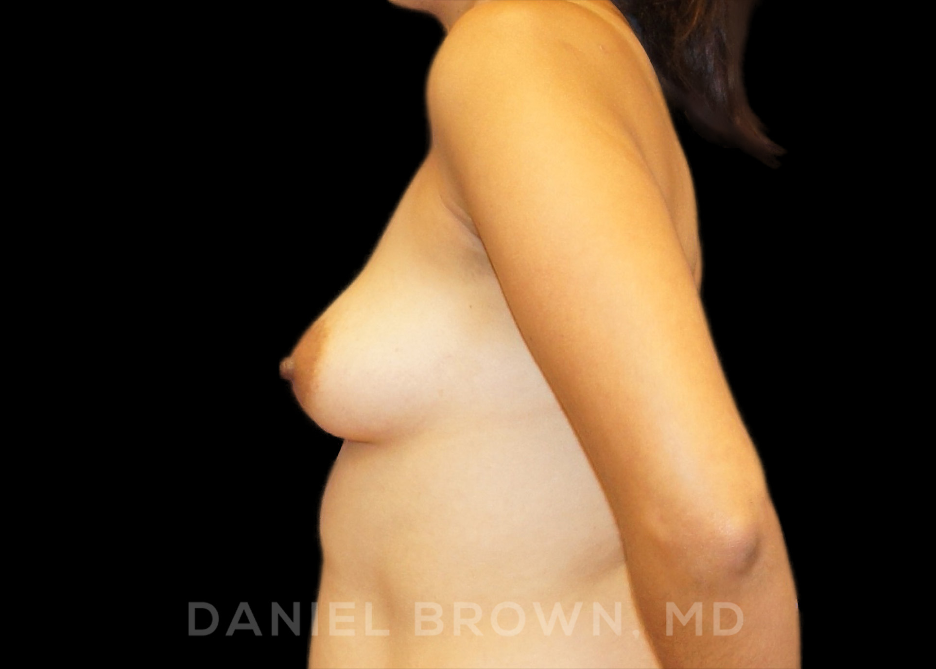 Breast Augmentation Patient Photo - Case 2203 - before view-2