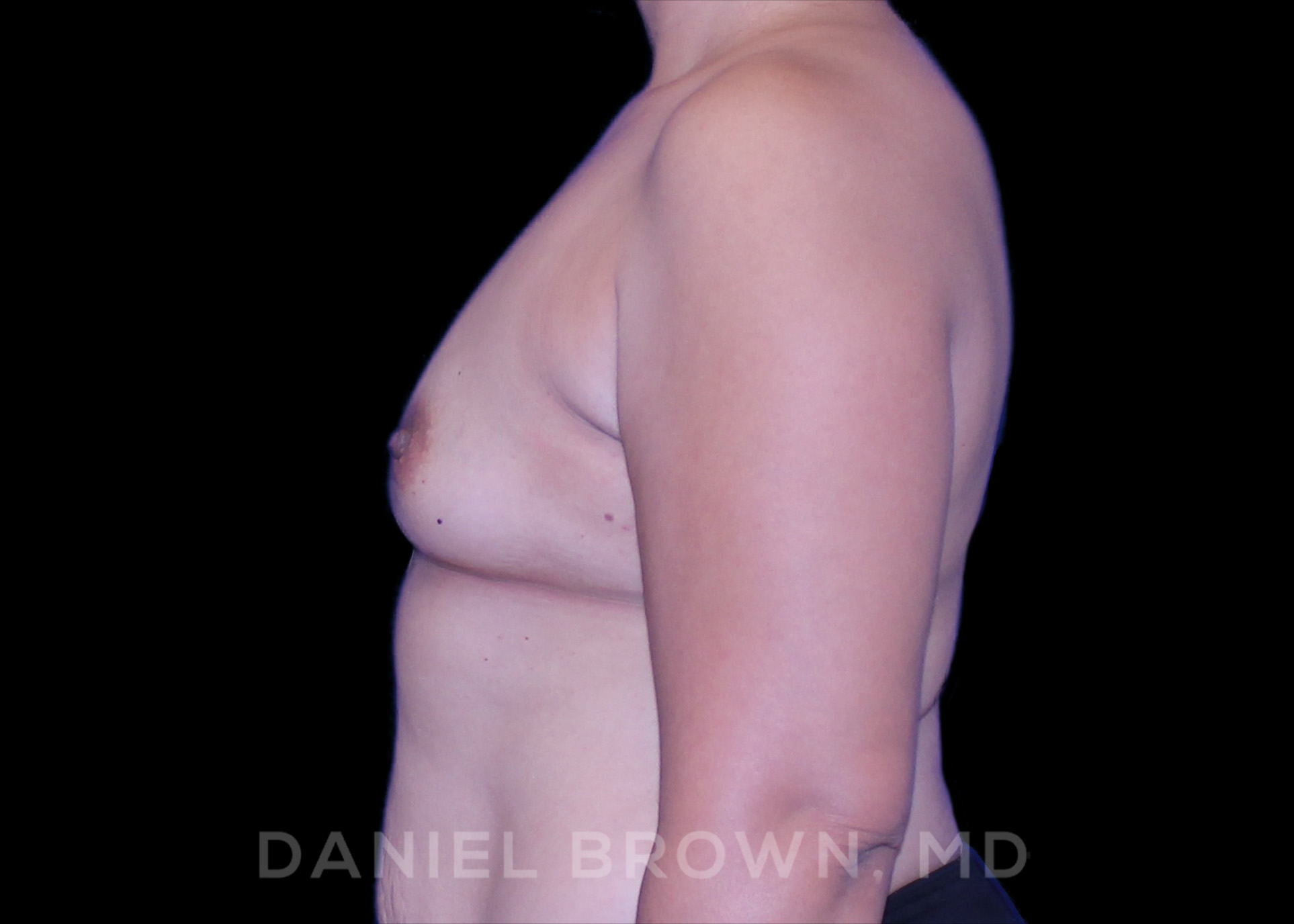 Breast Augmentation Patient Photo - Case 2210 - before view-2