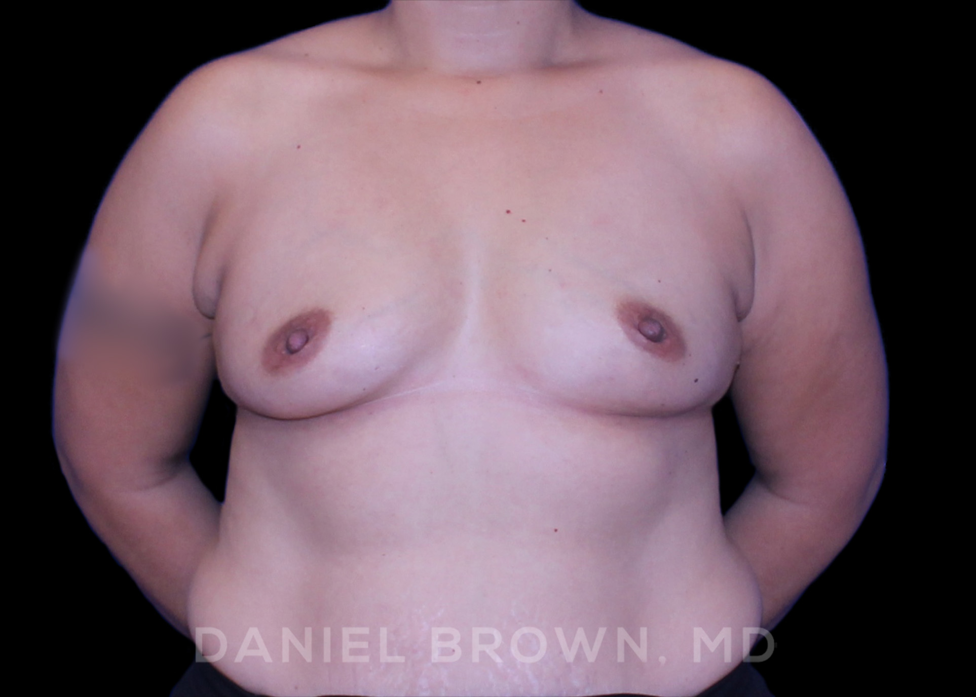 Breast Augmentation Patient Photo - Case 2210 - before view-0