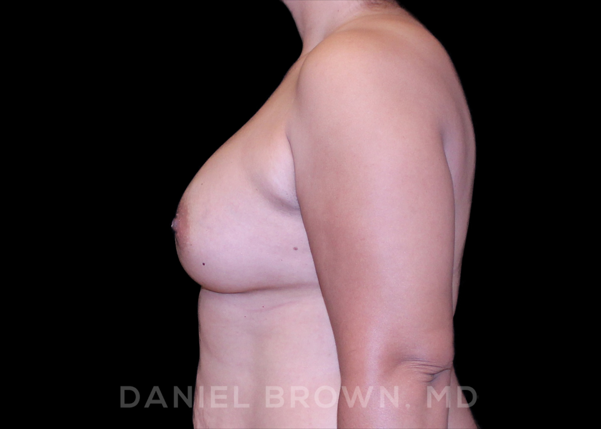 Breast Augmentation Patient Photo - Case 2210 - after view-2