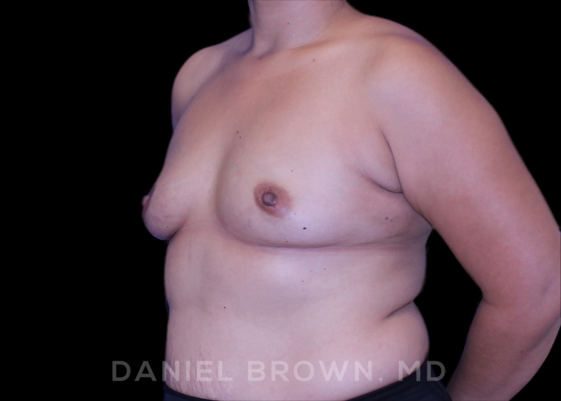 Breast Augmentation Patient Photo - Case 2210 - before view-1