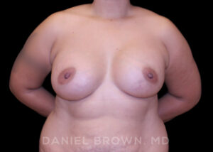 Breast Augmentation - Case 2210 - After