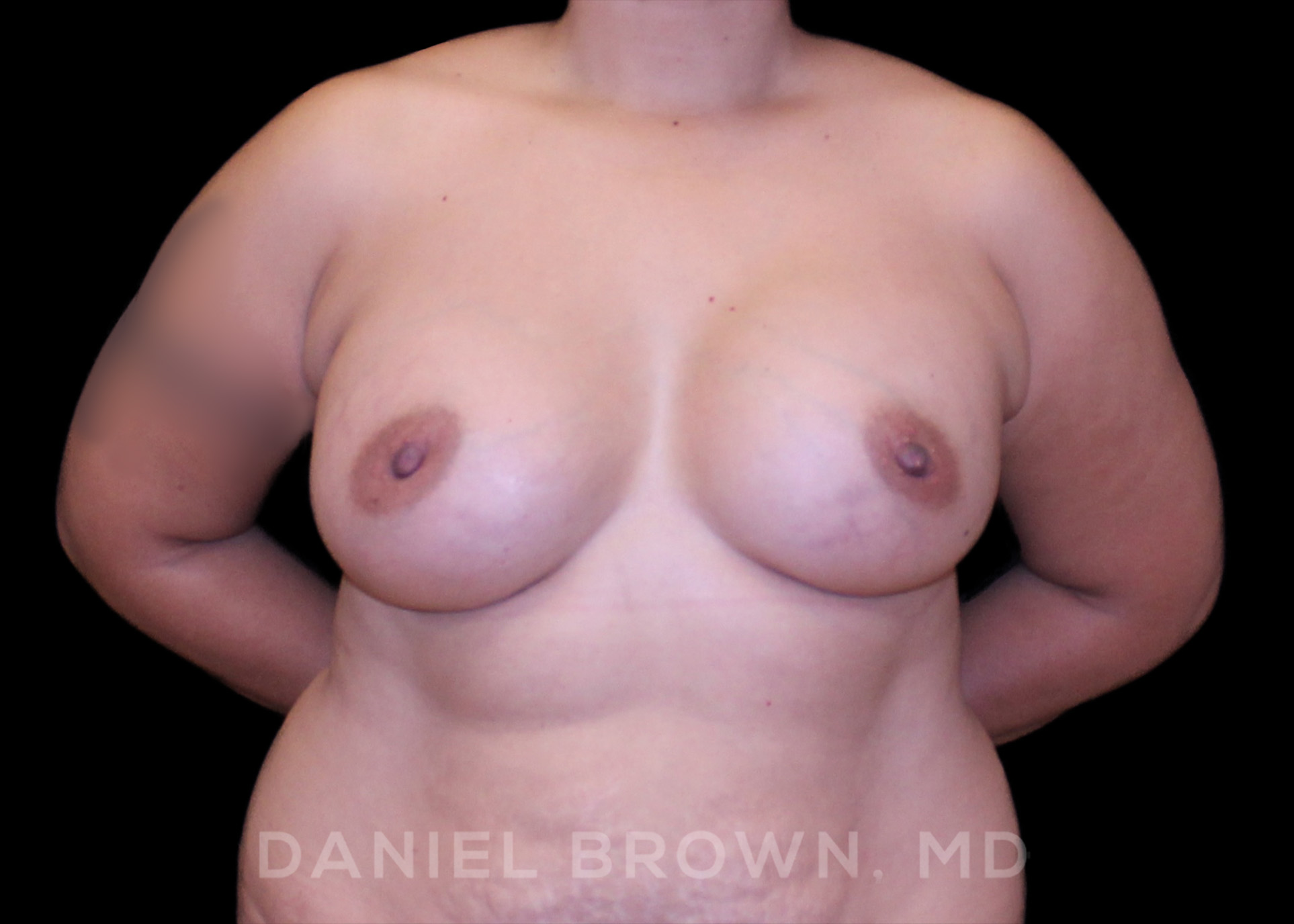 Breast Augmentation Patient Photo - Case 2210 - after view-0