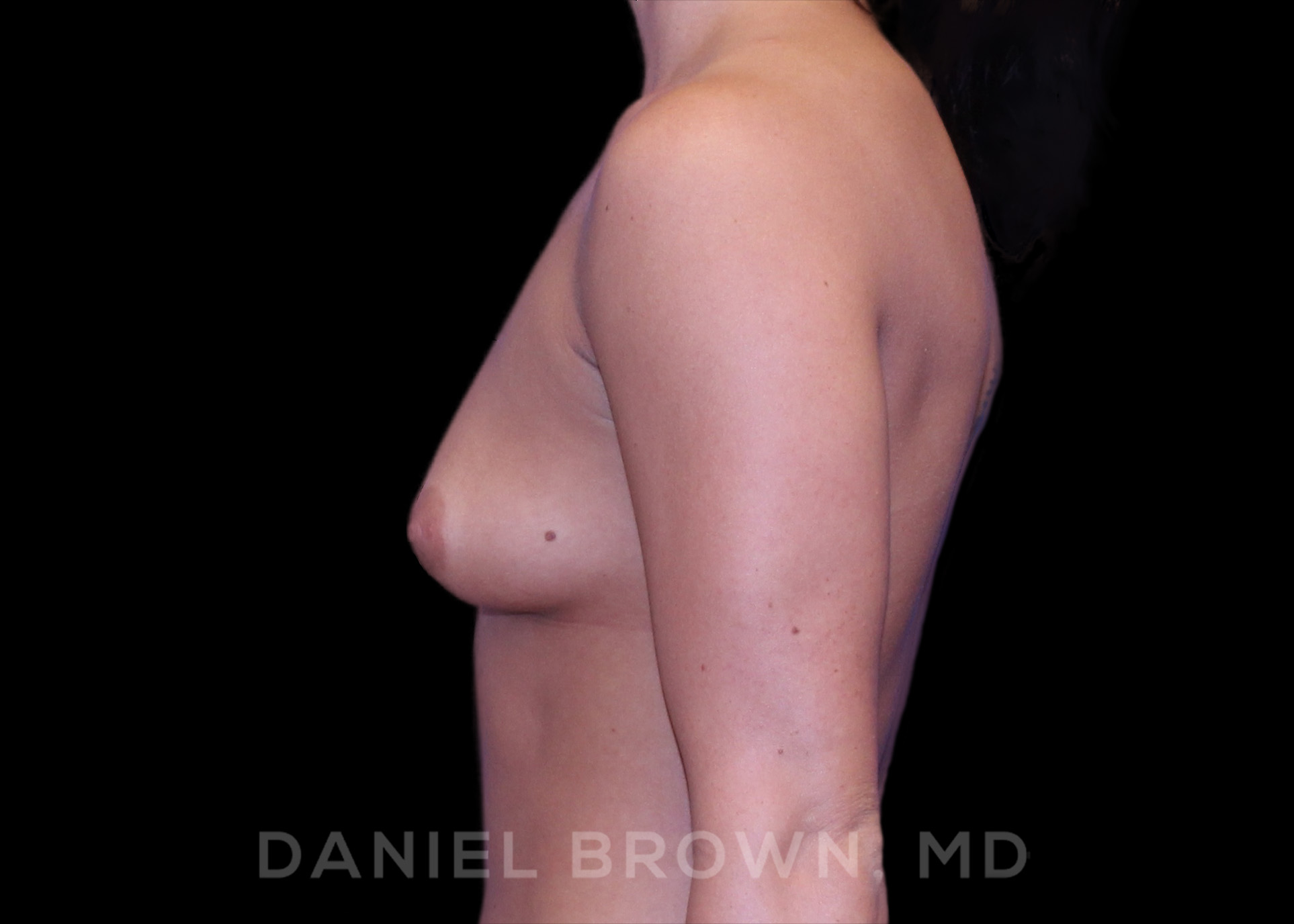 Breast Augmentation Patient Photo - Case 2217 - before view-