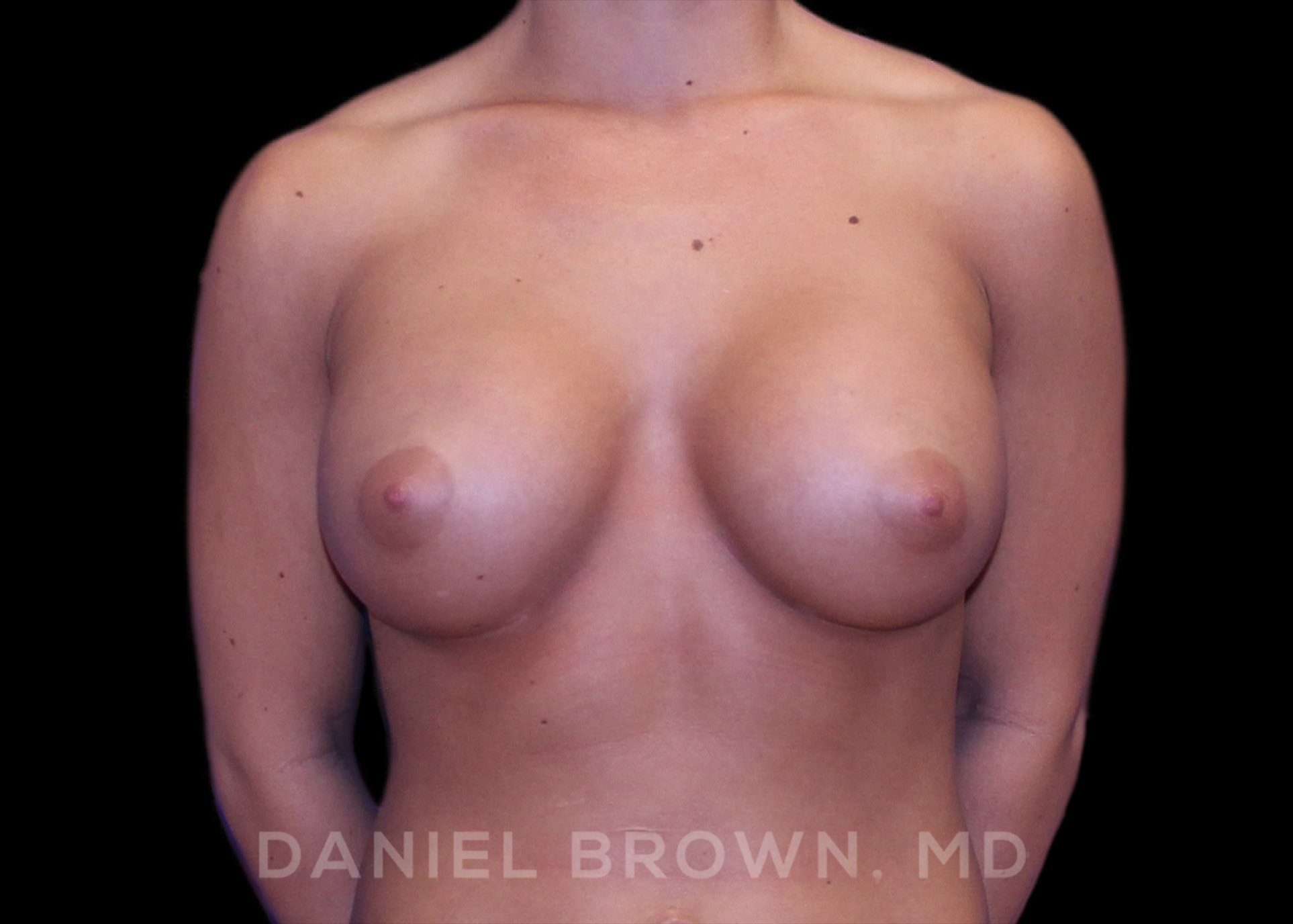 Breast Augmentation Patient Photo - Case 2217 - after view