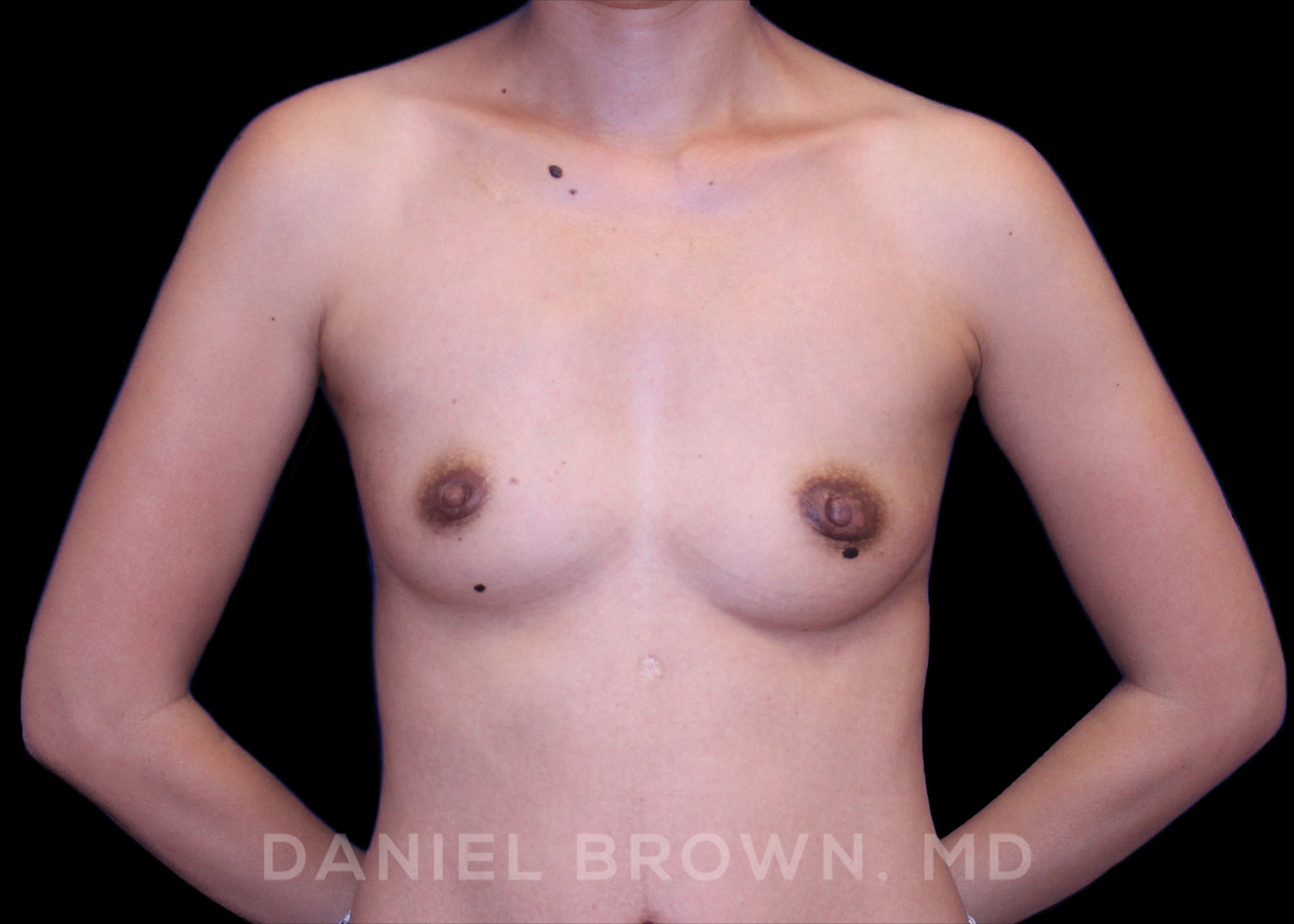 Breast Augmentation Patient Photo - Case 2224 - before view-0