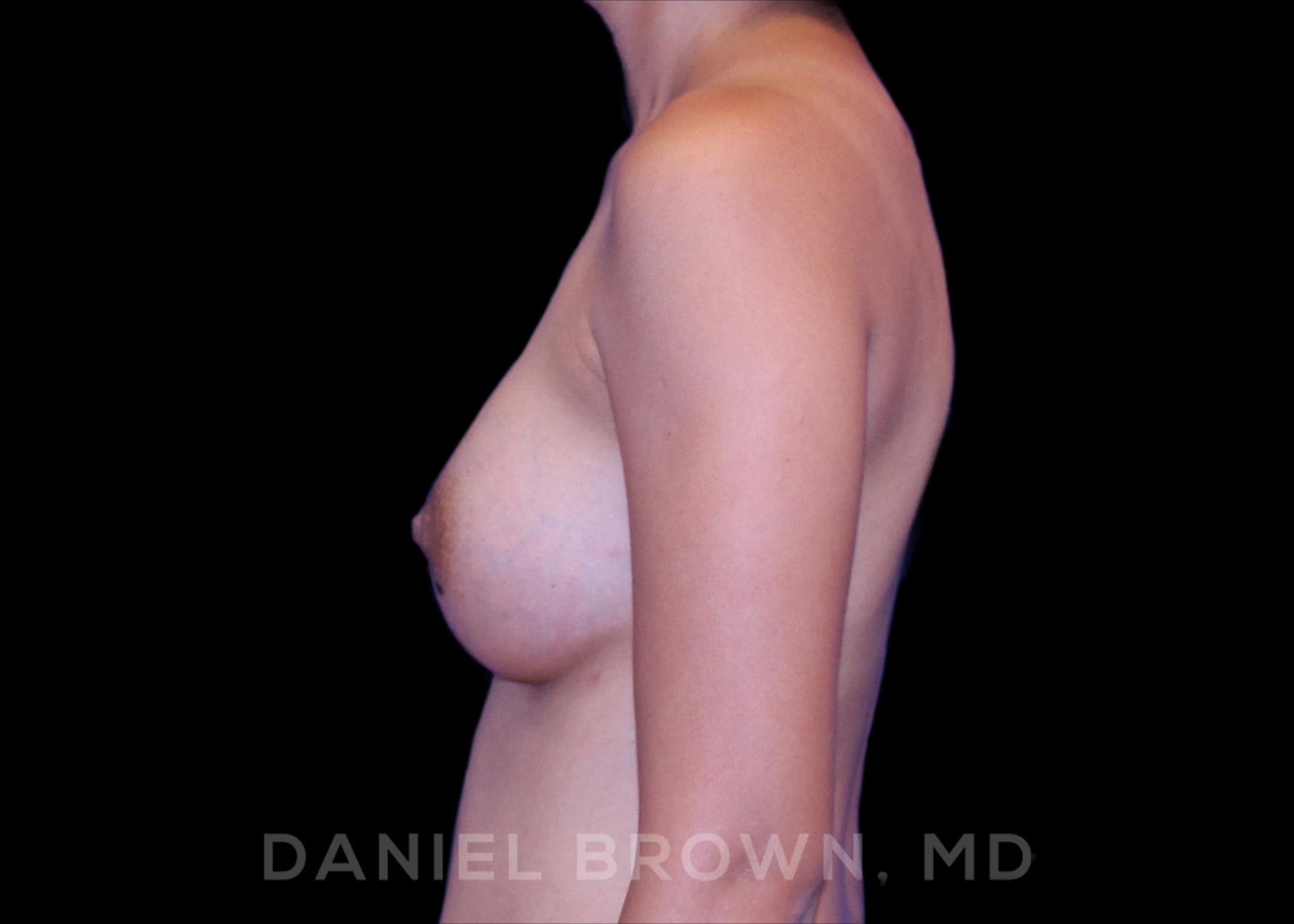 Breast Augmentation Patient Photo - Case 2224 - after view-2