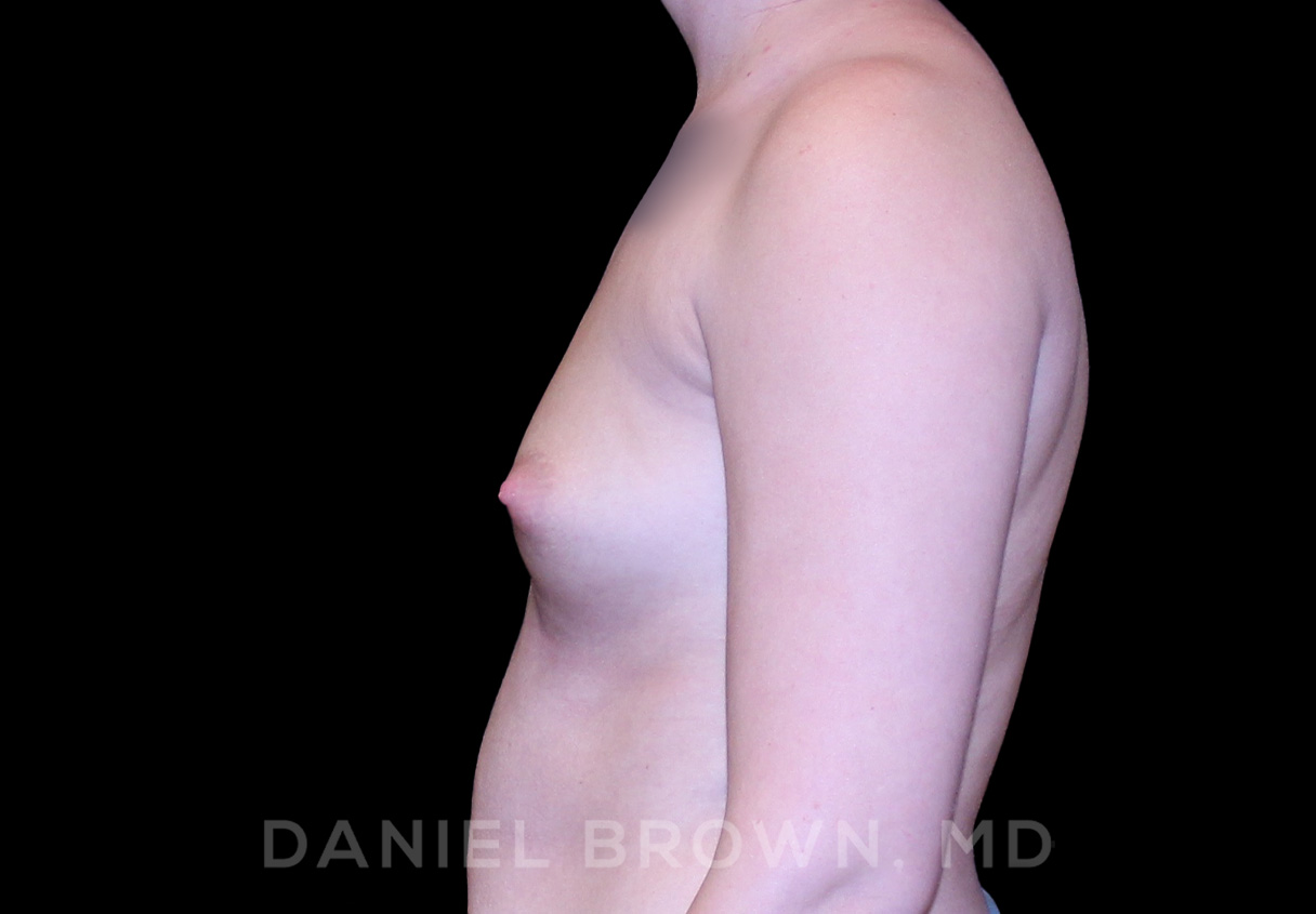 Breast Augmentation Patient Photo - Case 2231 - before view-