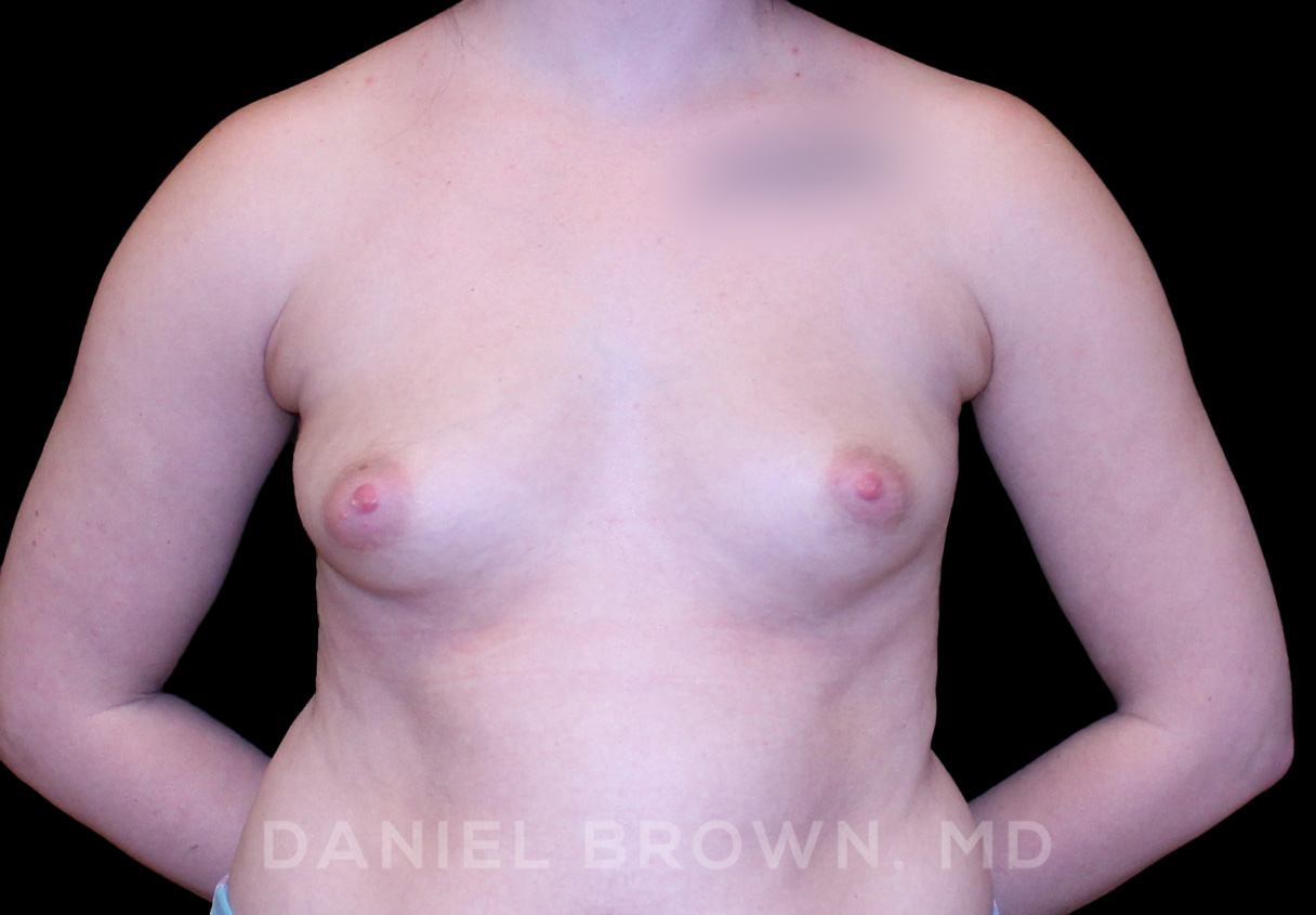 Breast Augmentation Patient Photo - Case 2231 - before view-
