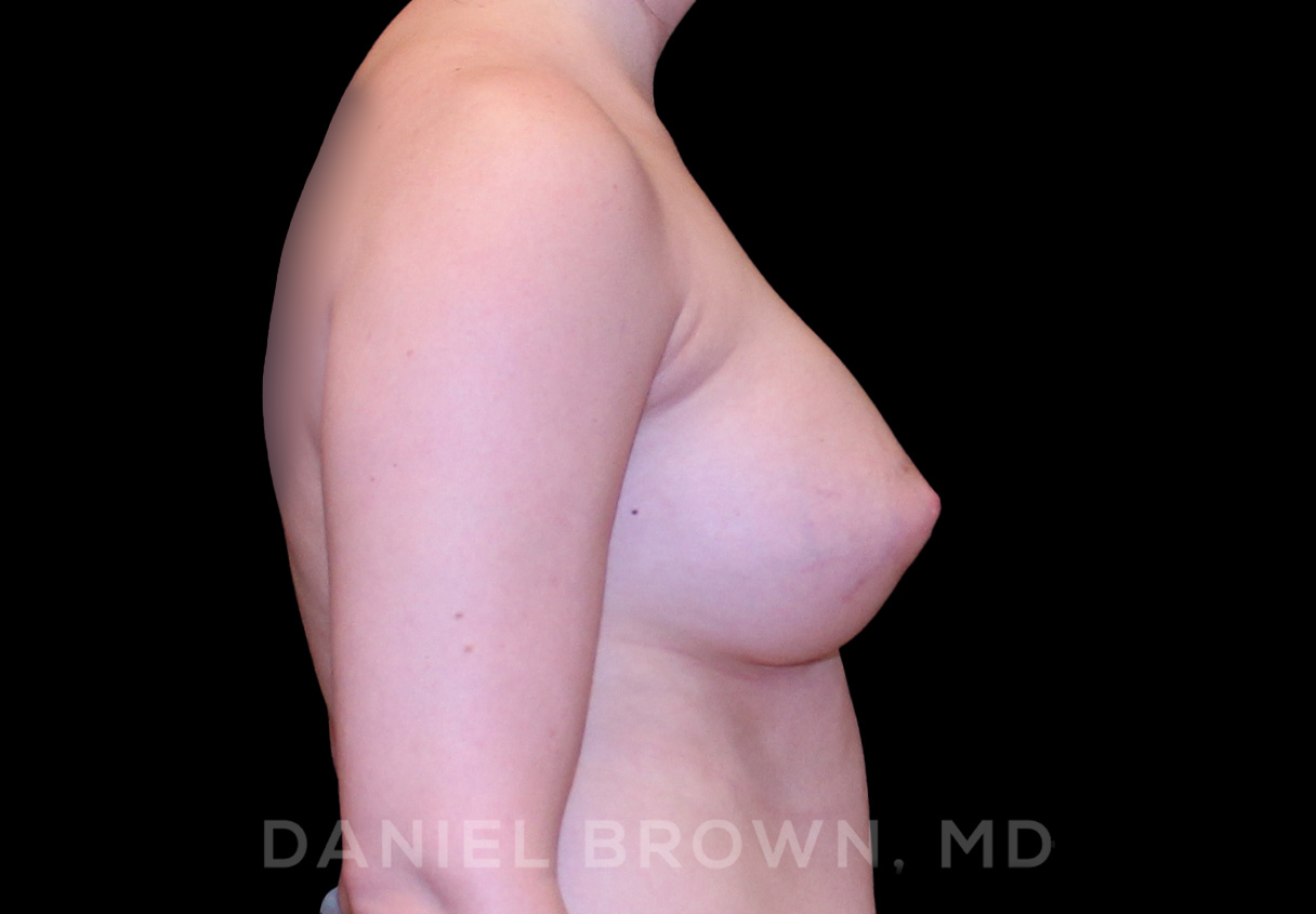 Breast Augmentation Patient Photo - Case 2231 - after view