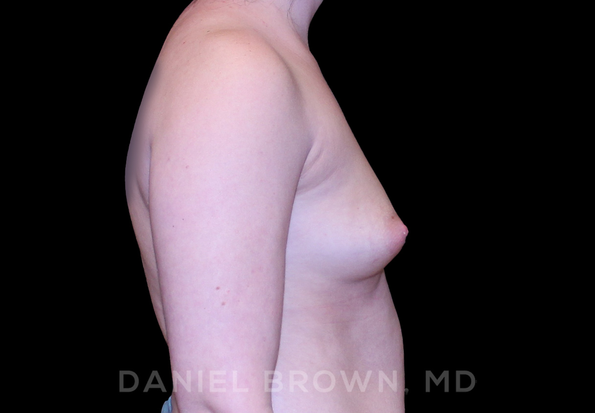 Breast Augmentation Patient Photo - Case 2231 - before view-4